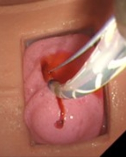 出血合併症再現の画像