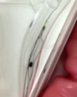 胆管結石除去の画像